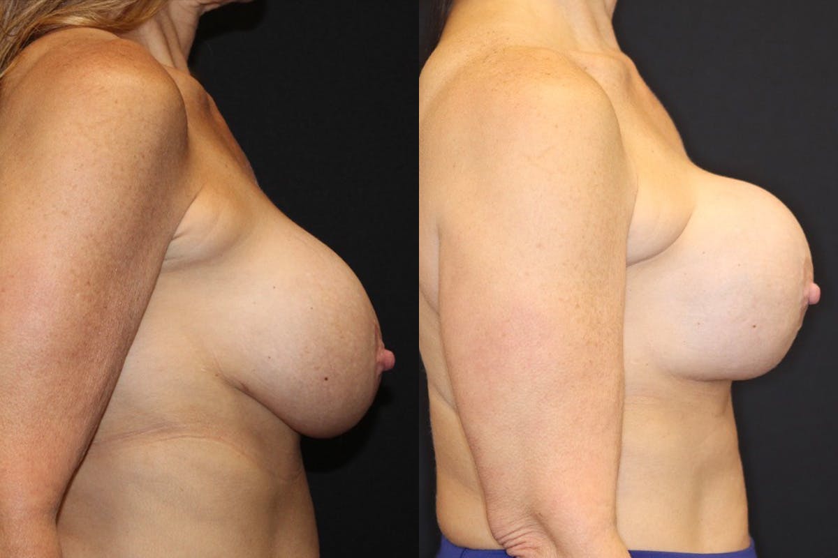 Breast Implant Exchange Before & After Gallery - Patient 276455 - Image 3
