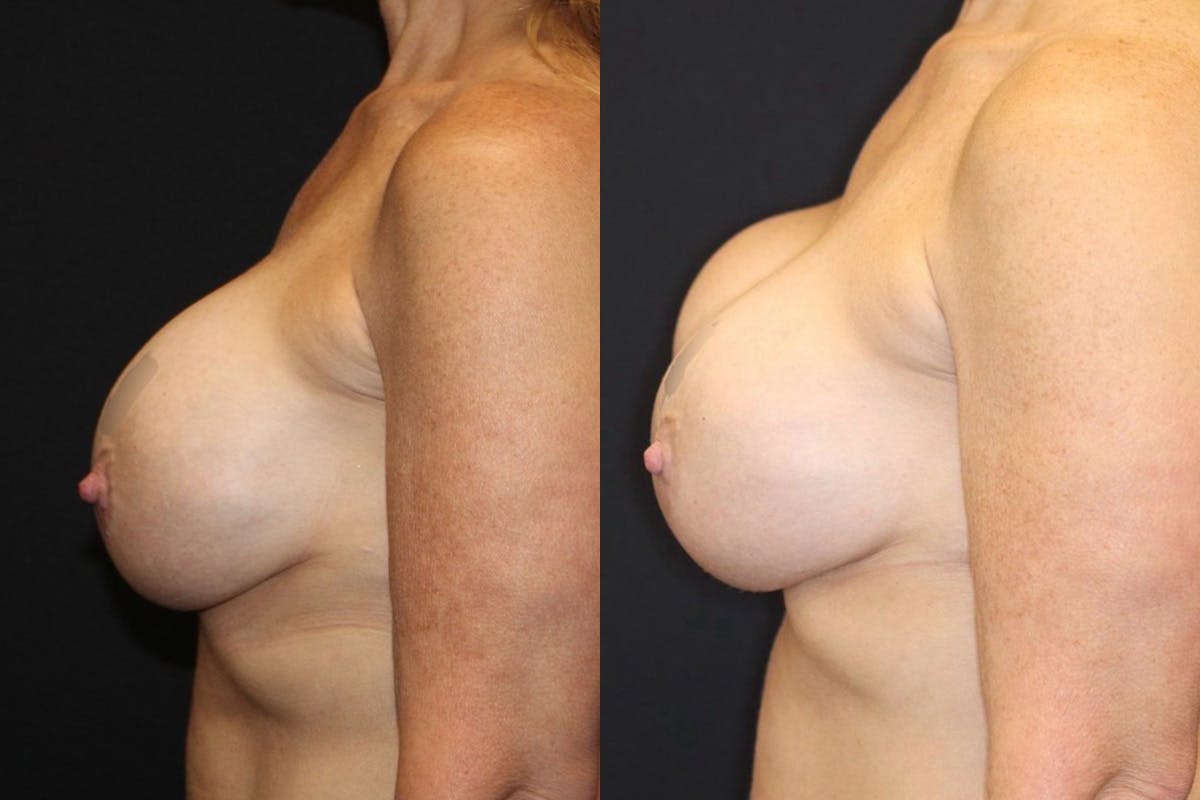 Breast Implant Exchange Before & After Gallery - Patient 276455 - Image 2