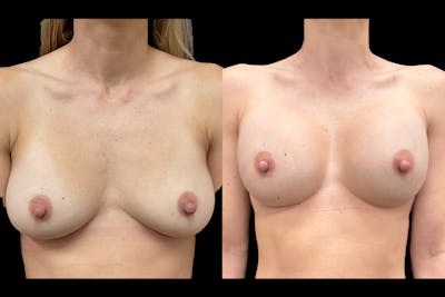 Breast Implant Exchange Before & After Gallery - Patient 280459 - Image 1