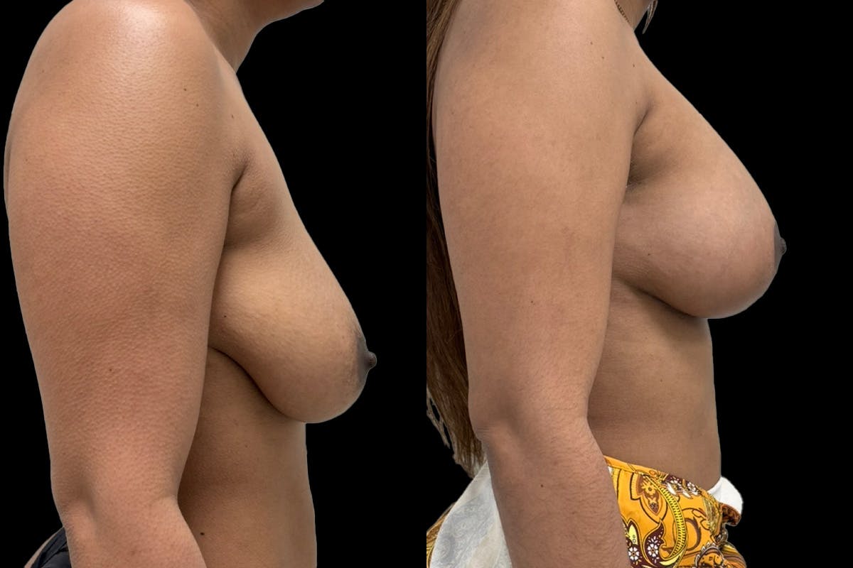Breast Augmentation + Lift Before & After Gallery - Patient 426653 - Image 2