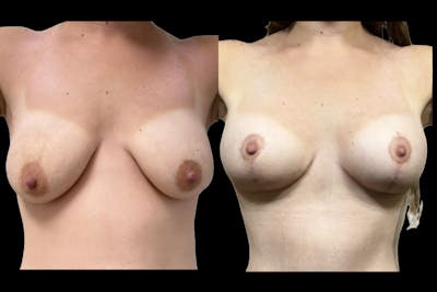 Breast Augmentation + Lift Before & After Gallery - Patient 195126 - Image 1