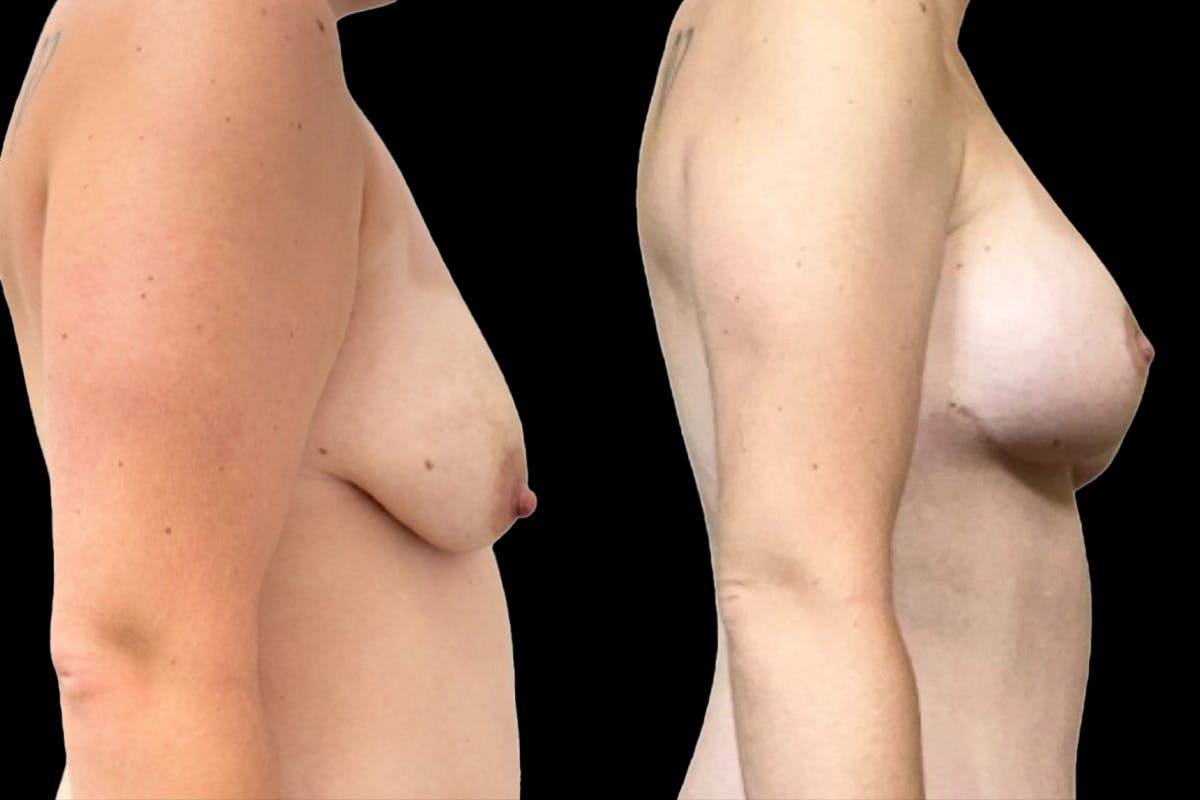 Breast Augmentation + Lift Before & After Gallery - Patient 195126 - Image 2