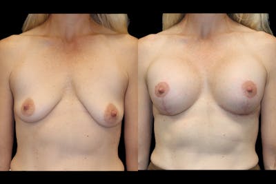 Breast Augmentation + Lift Before & After Gallery - Patient 314296 - Image 1