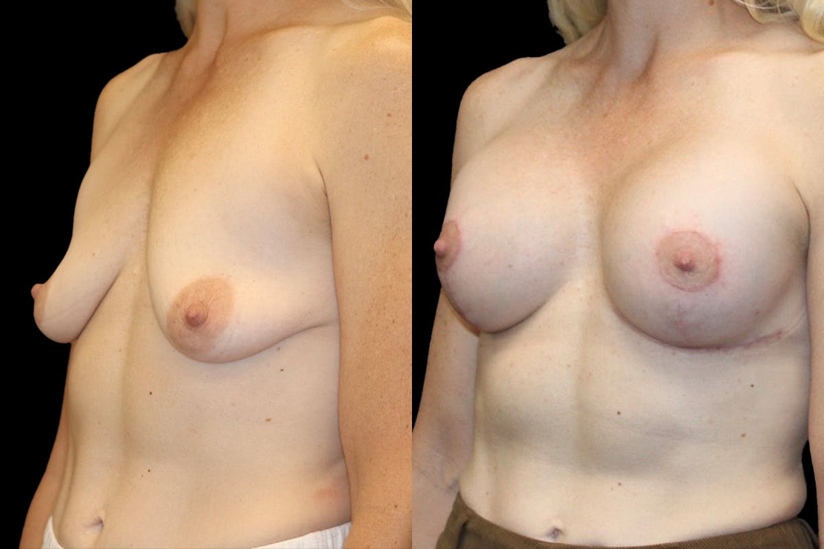 Breast Augmentation + Lift Before & After Gallery - Patient 314296 - Image 2