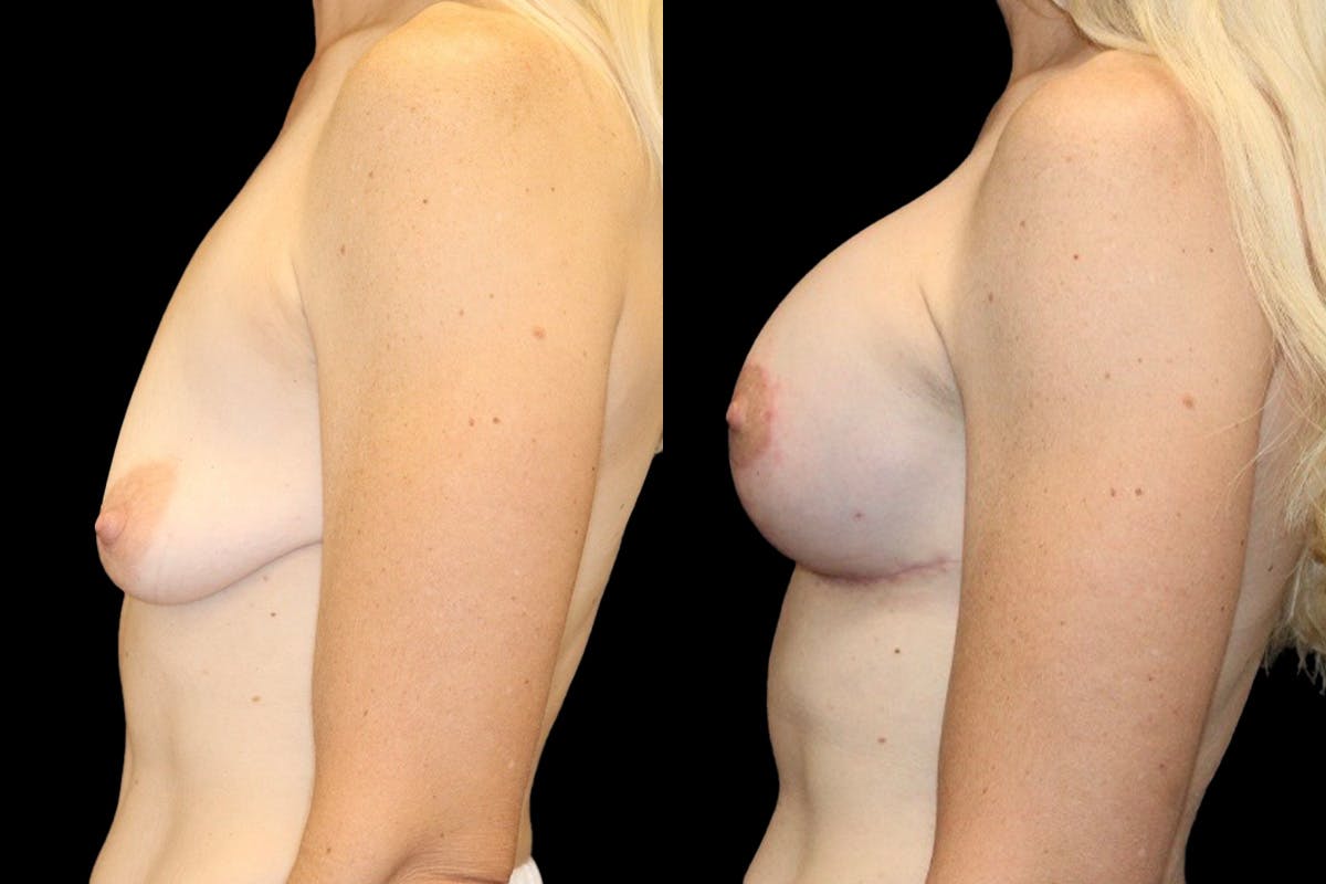 Breast Augmentation + Lift Before & After Gallery - Patient 314296 - Image 3