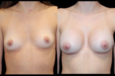 Breast Augmentation Before & After Gallery - Patient 541532 - Image 1