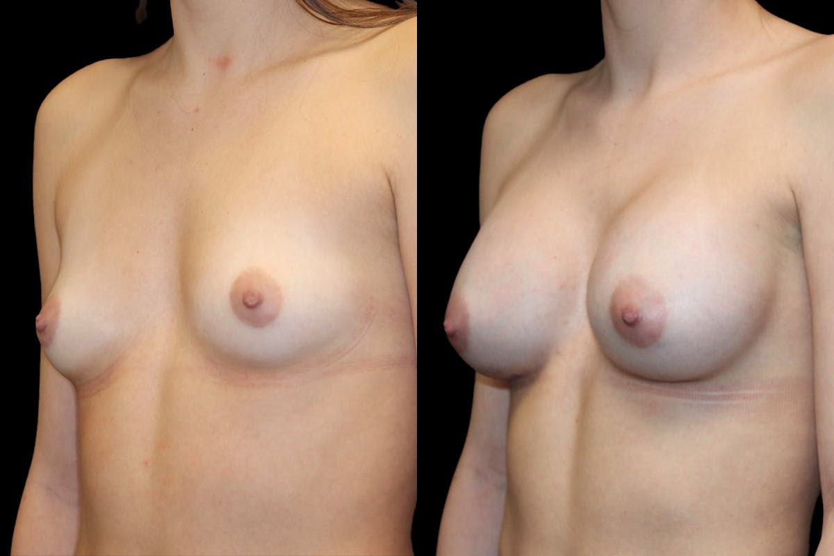 Breast Augmentation Before & After Gallery - Patient 541532 - Image 4