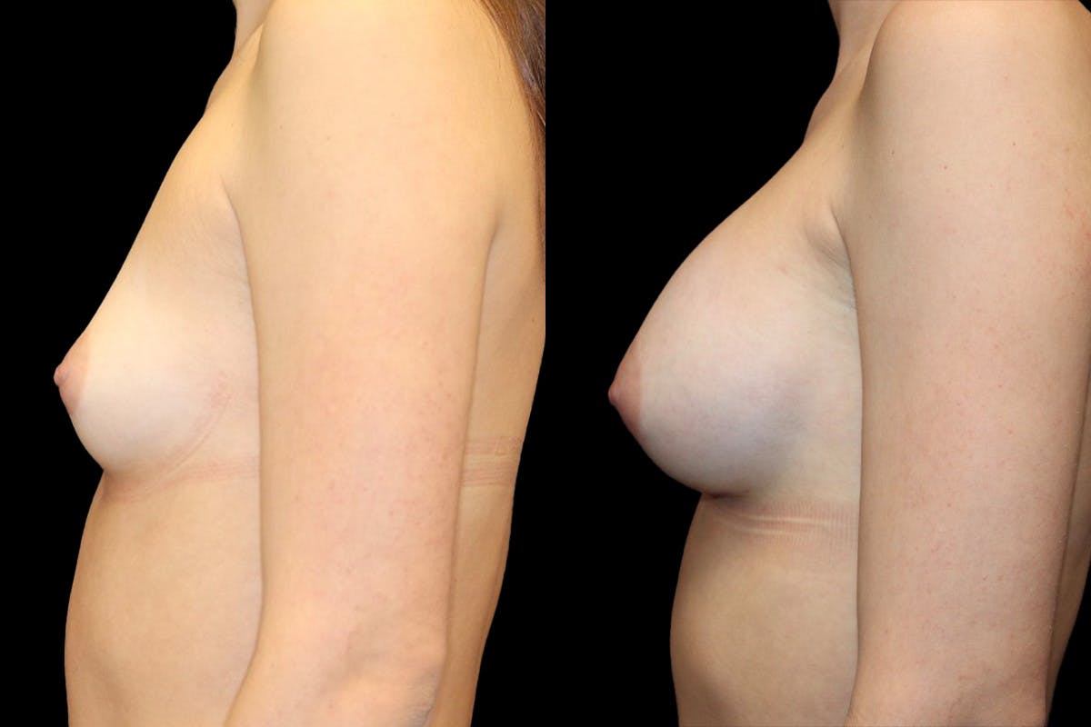 Breast Augmentation Before & After Gallery - Patient 541532 - Image 5