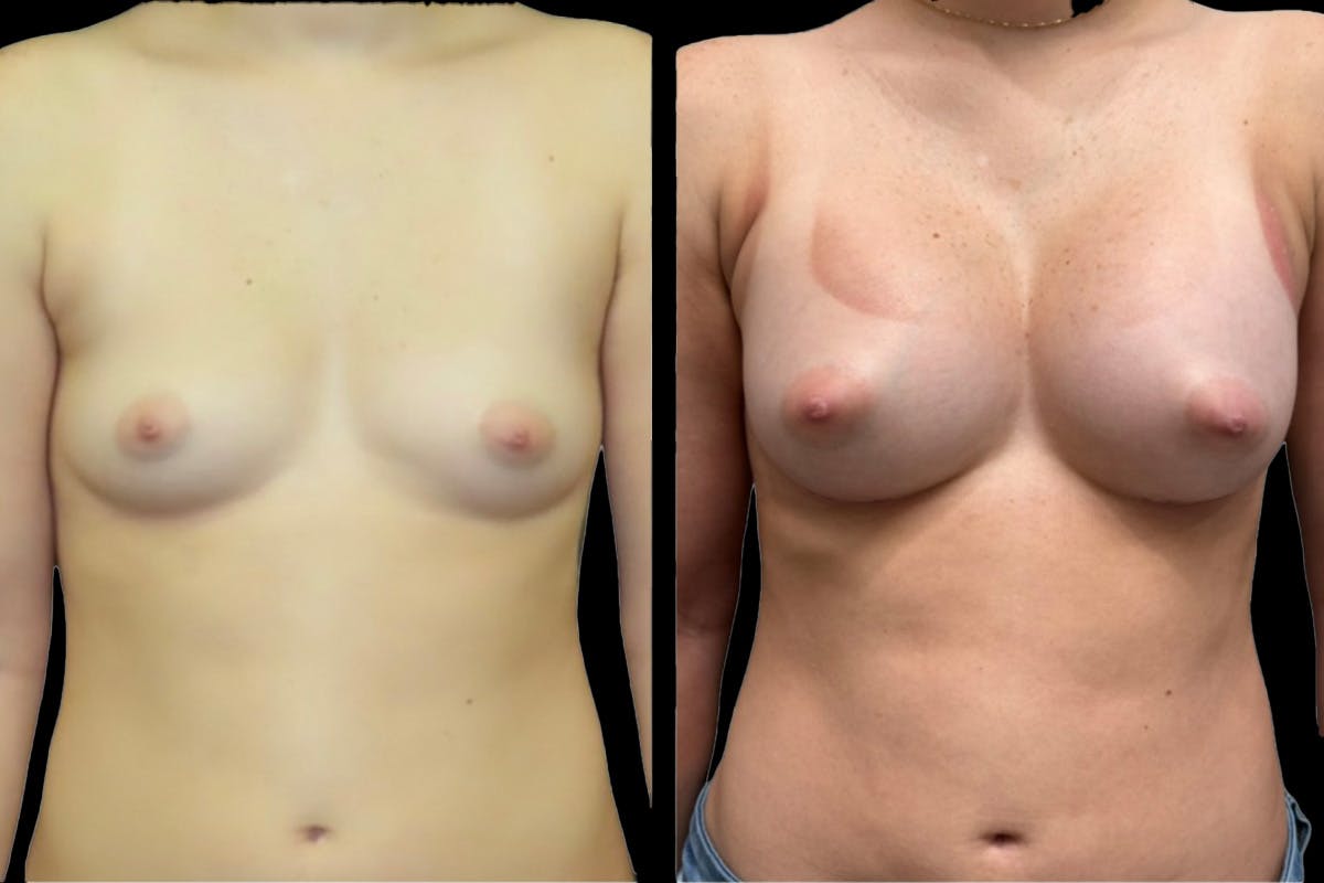 Breast Augmentation Before & After Gallery - Patient 405157 - Image 1