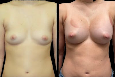 Breast Augmentation Before & After Gallery - Patient 405157 - Image 1