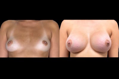 Breast Augmentation Before & After Gallery - Patient 188932 - Image 1