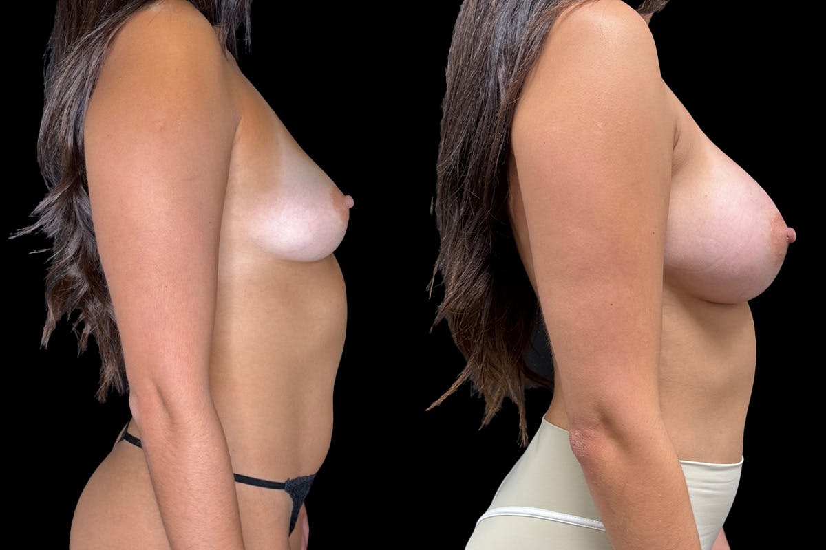 Breast Augmentation Before & After Gallery - Patient 188932 - Image 2