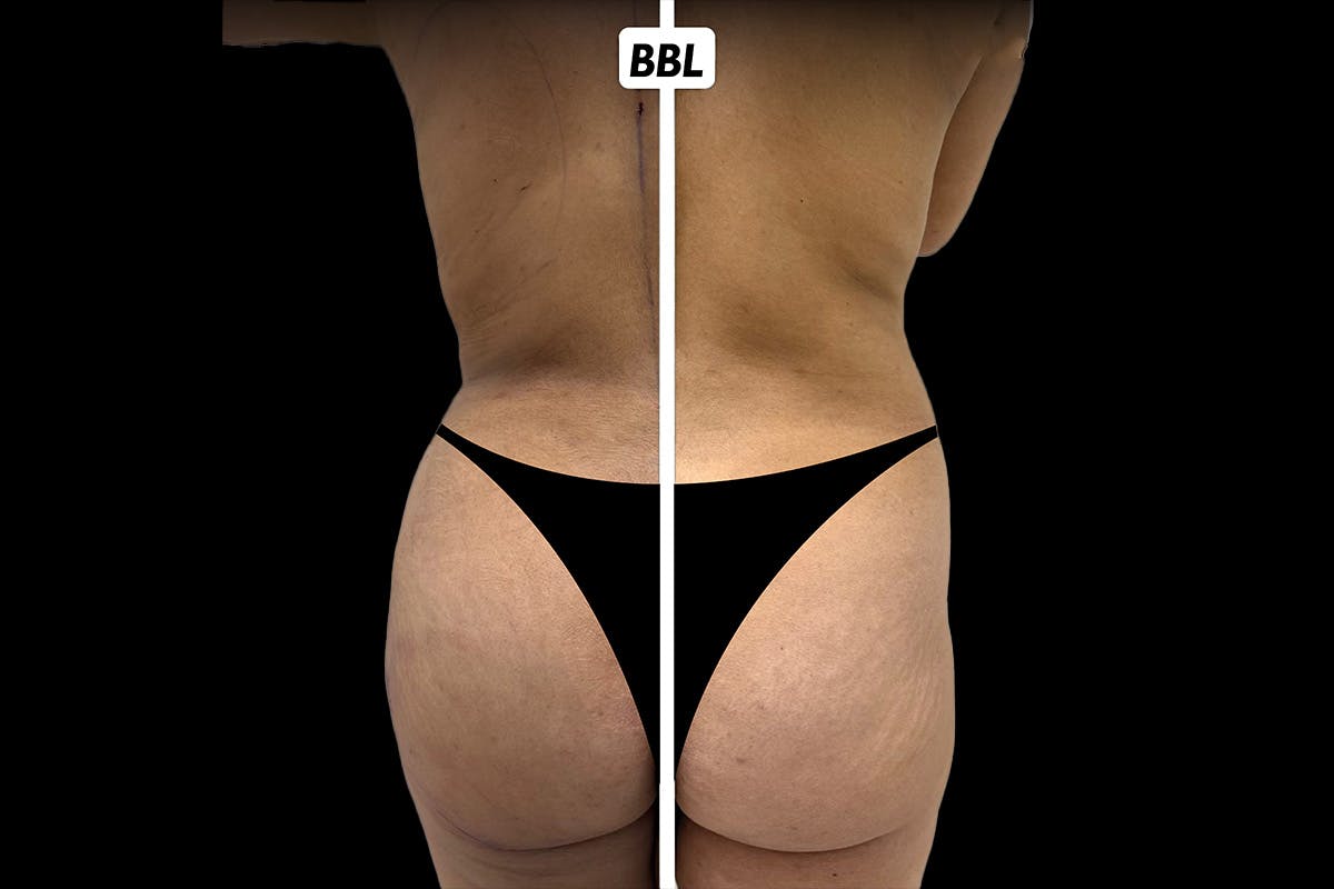 Brazilian Butt Lift Before & After Gallery - Patient 411554 - Image 1