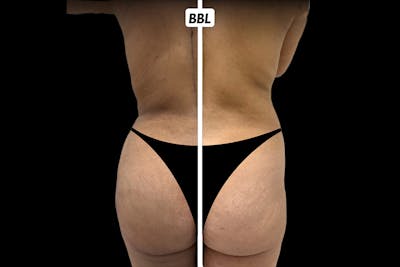 Brazilian Butt Lift Before & After Gallery - Patient 411554 - Image 1