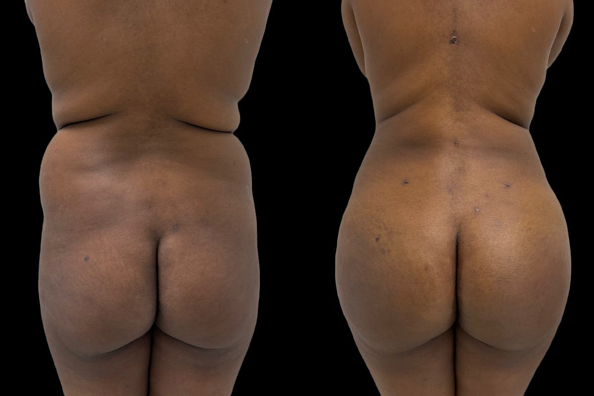 Brazilian Butt Lift Before & After Gallery - Patient 250250 - Image 1