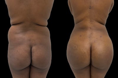 Brazilian Butt Lift Before & After Gallery - Patient 250250 - Image 1