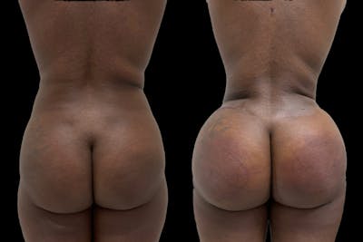 Brazilian Butt Lift Before & After Gallery - Patient 401923 - Image 1