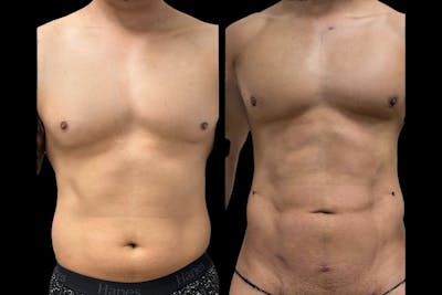 Abdominal Etching Before & After Gallery - Patient 158222 - Image 1