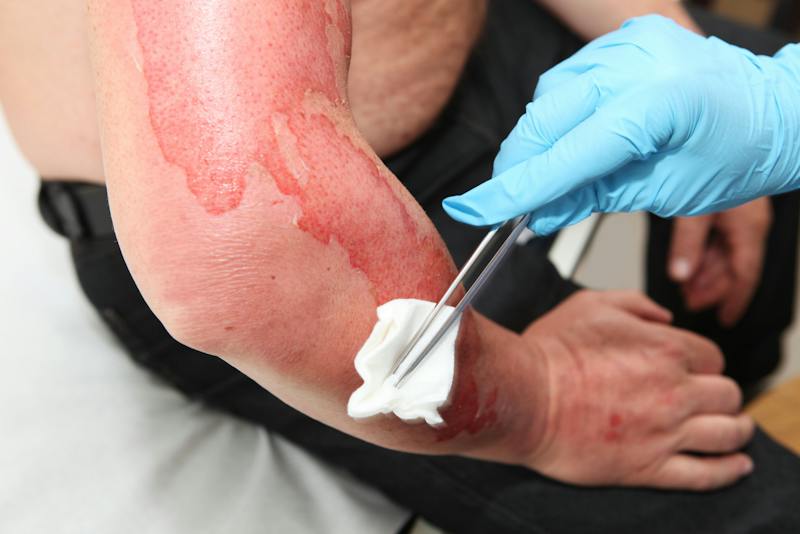 doctor treating a third degree burn on patients arm