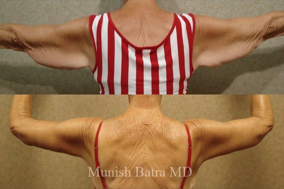 Arm Lift Before & After Gallery - Patient 261038 - Image 1