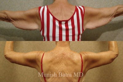Arm Lift Before & After Gallery - Patient 261038 - Image 1