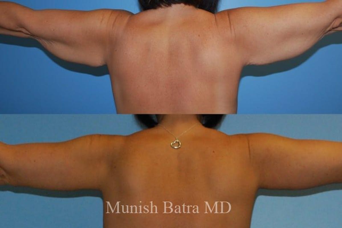 Arm Lift Before & After Gallery - Patient 286067 - Image 1
