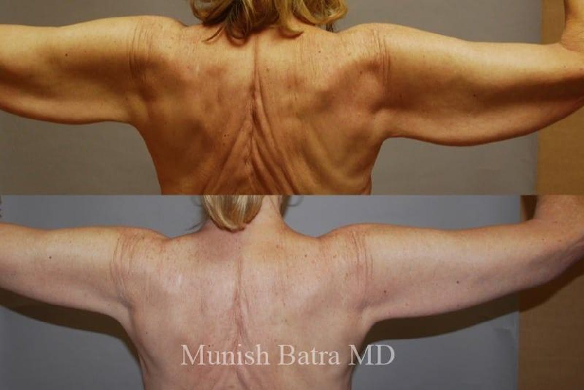 Arm Lift Before & After Gallery - Patient 649089 - Image 1