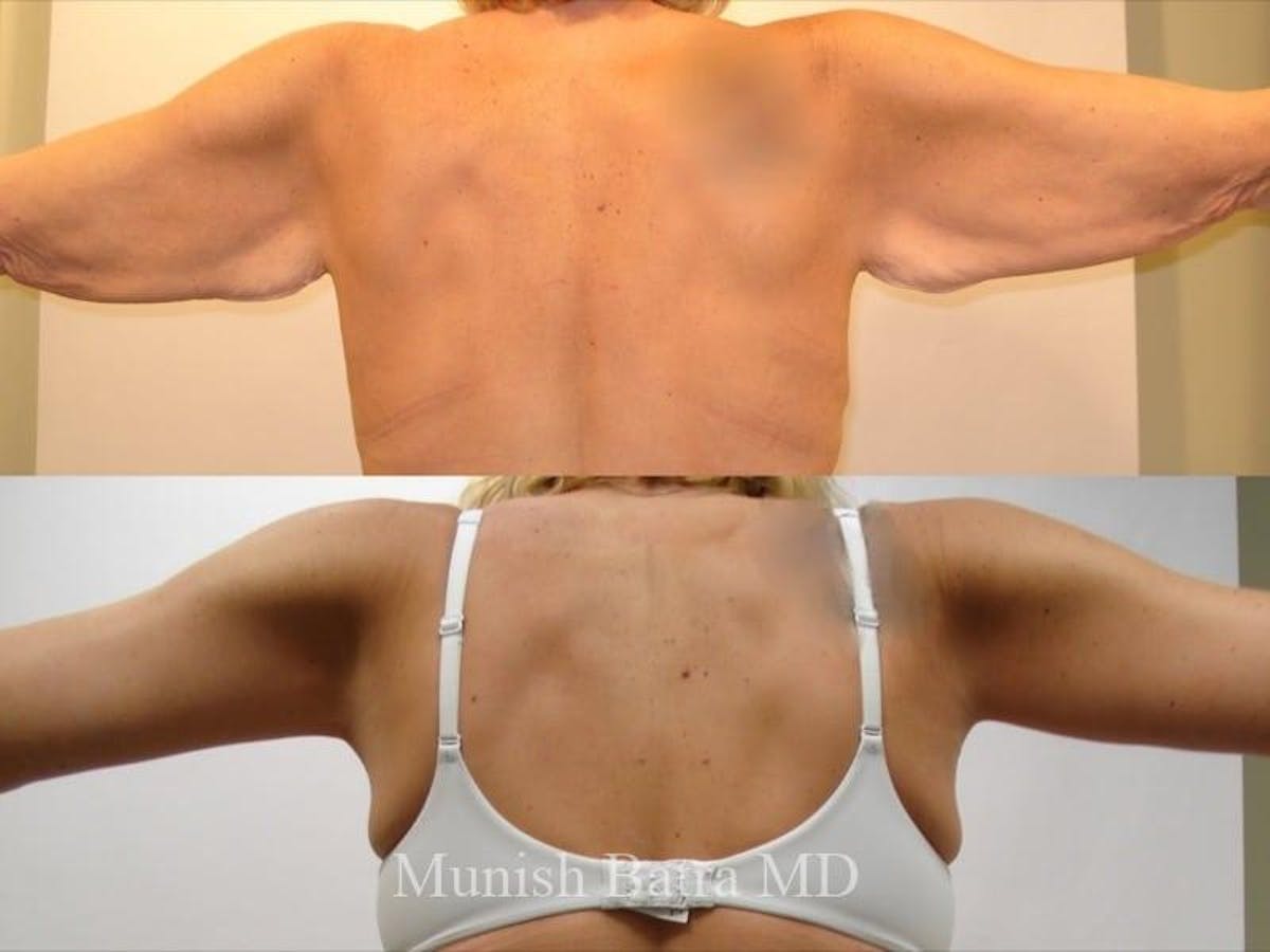 Arm Lift Before & After Gallery - Patient 263044 - Image 1