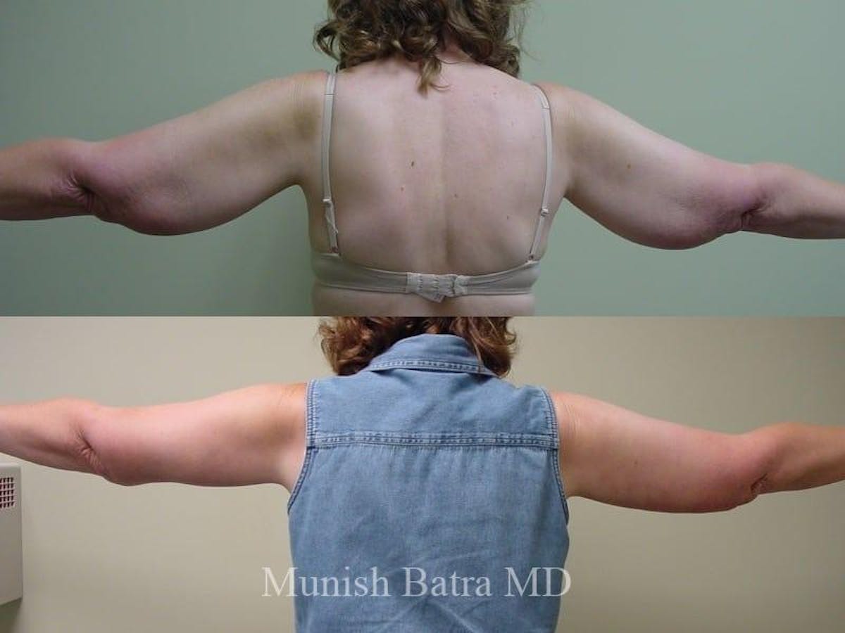 Arm Lift Before & After Gallery - Patient 224223 - Image 1