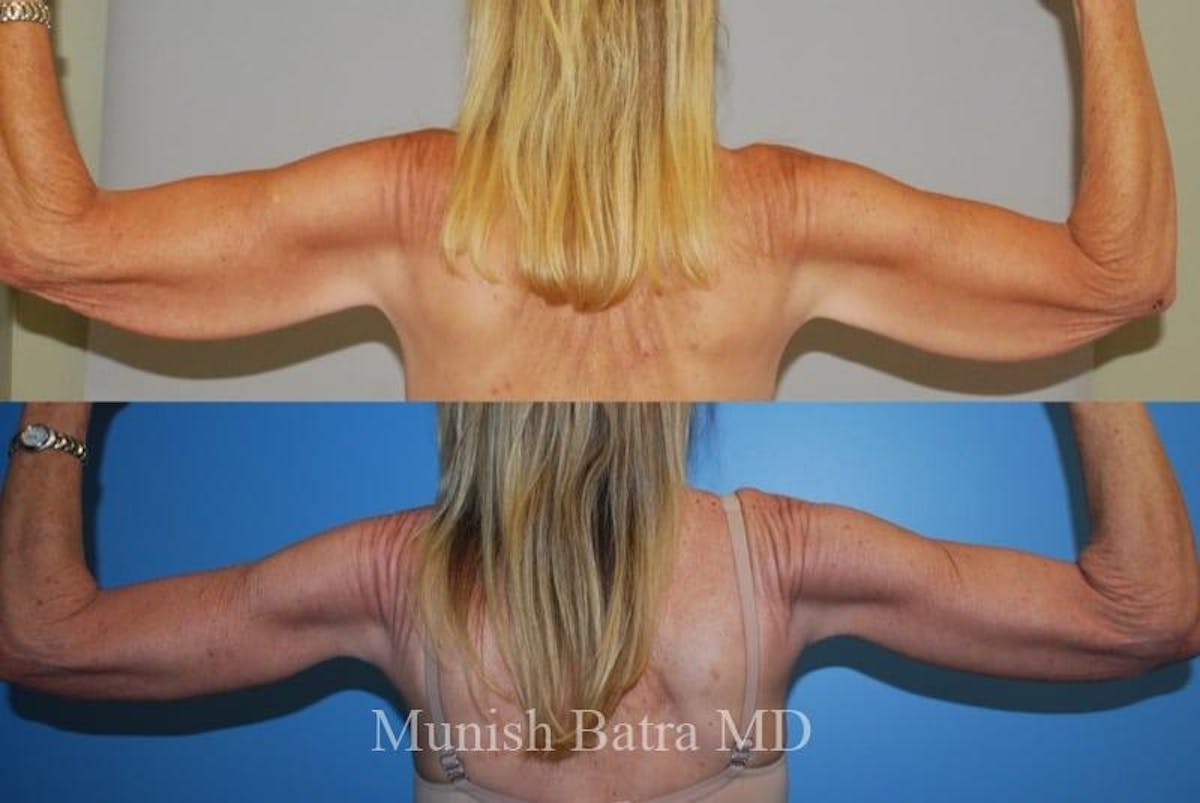 Arm Lift Before & After Gallery - Patient 121840 - Image 1