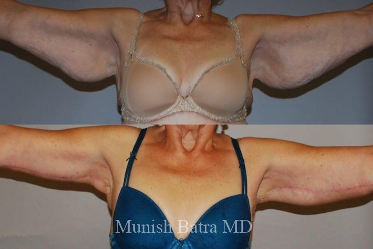 Arm Lift Before & After Gallery - Patient 714668 - Image 1