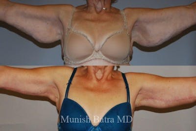 Arm Lift Before & After Gallery - Patient 714668 - Image 1