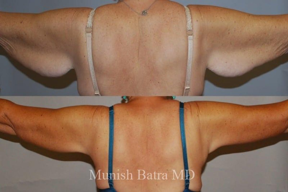 Arm Lift Before & After Gallery - Patient 714668 - Image 2
