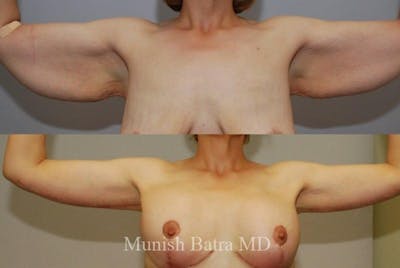Arm Lift Before & After Gallery - Patient 174816 - Image 1