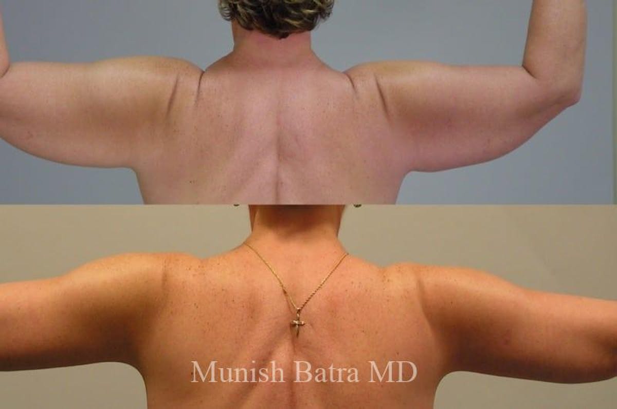 Arm Lift Before & After Gallery - Patient 189896 - Image 1