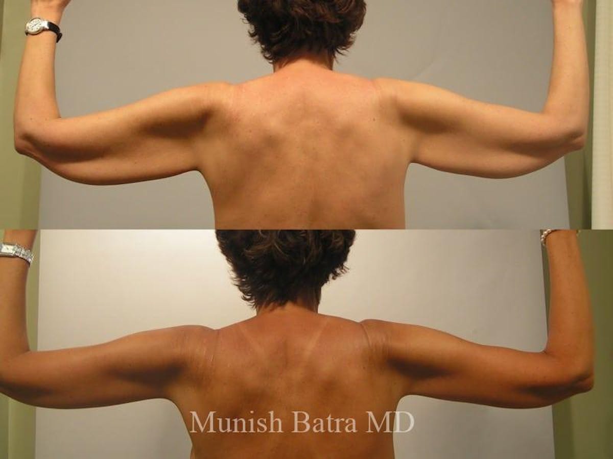 Arm Lift Before & After Gallery - Patient 293045 - Image 1