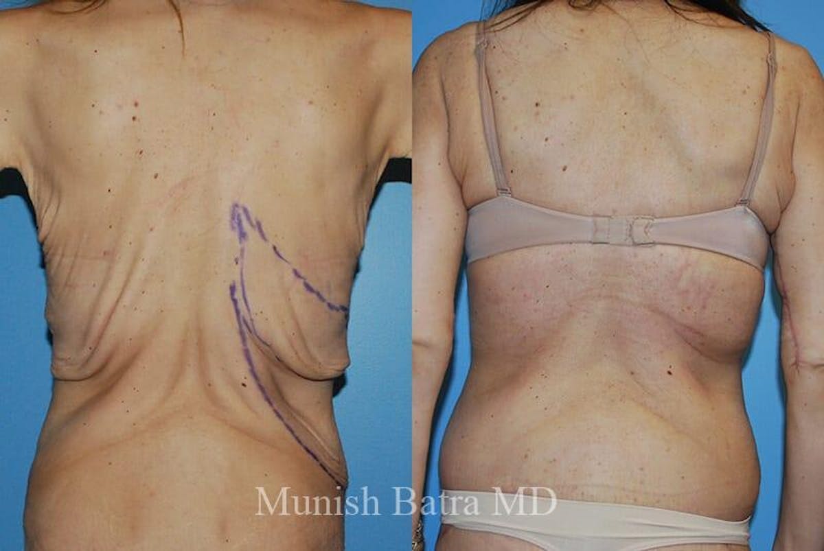 Back Excision Before & After Gallery - Patient 427749 - Image 1