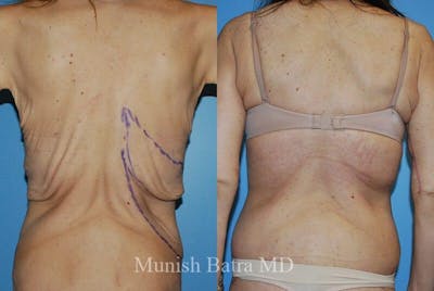 Back Excision Before & After Gallery - Patient 427749 - Image 1