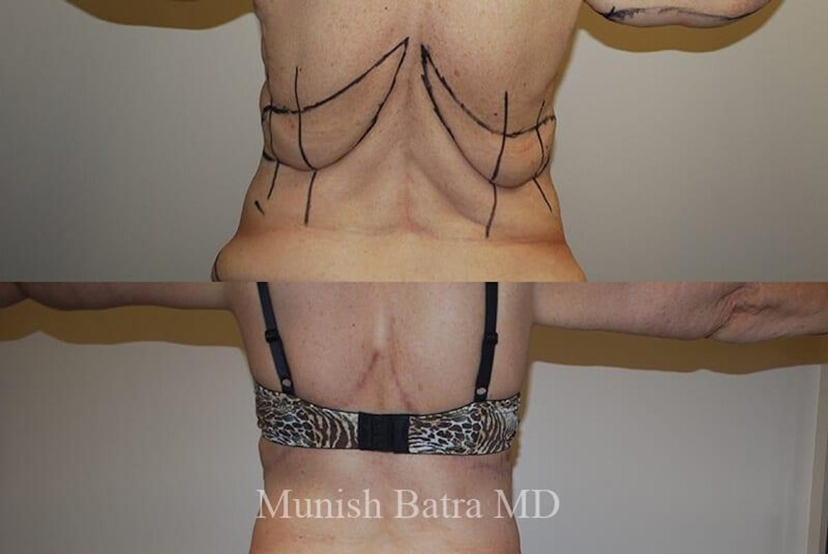 Back Excision Before & After Gallery - Patient 162086 - Image 1