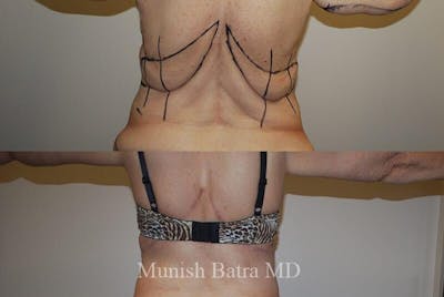 Back Excision Before & After Gallery - Patient 162086 - Image 1