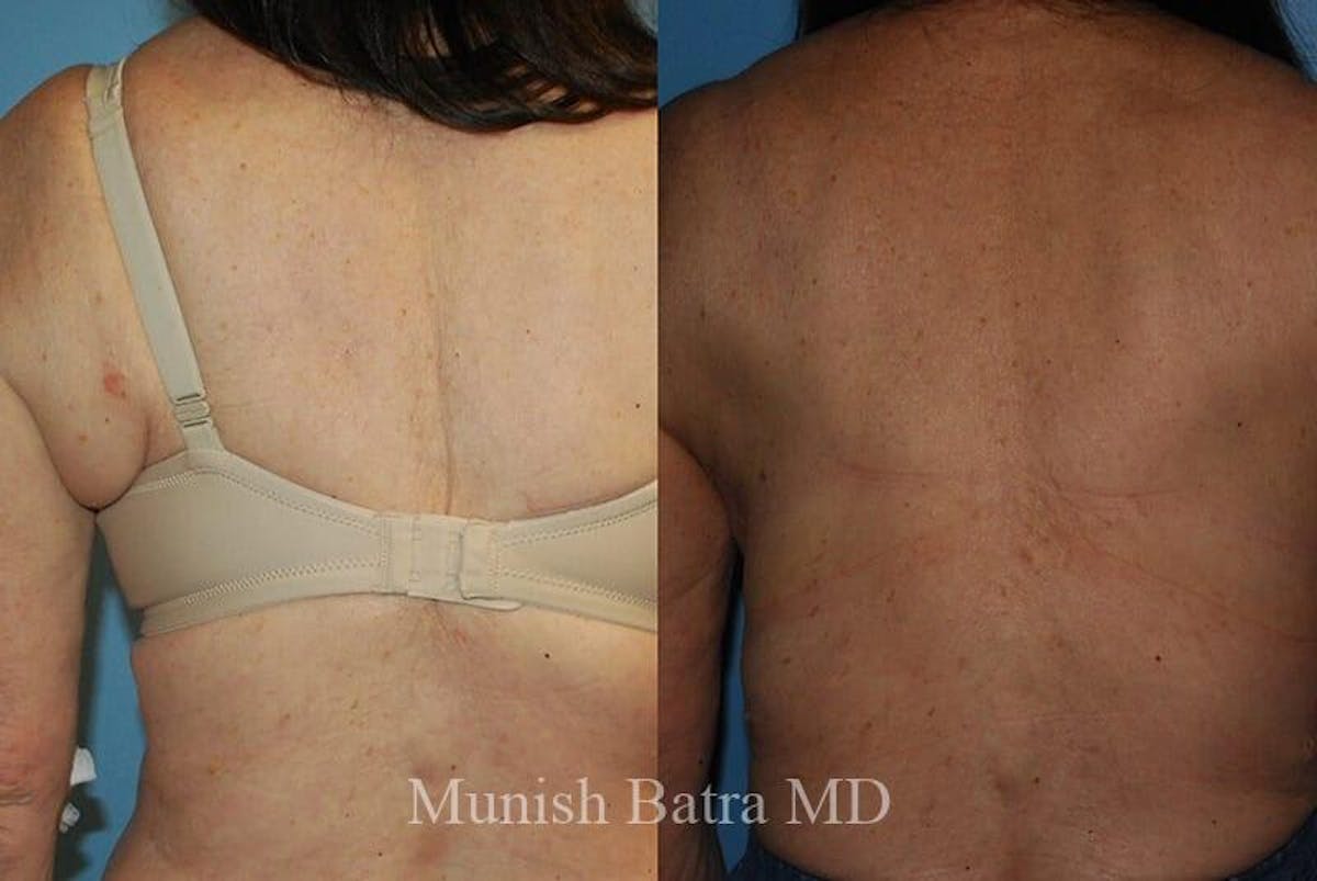 Back Excision Before & After Gallery - Patient 948042 - Image 1