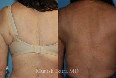 Back Excision Before & After Gallery - Patient 948042 - Image 1