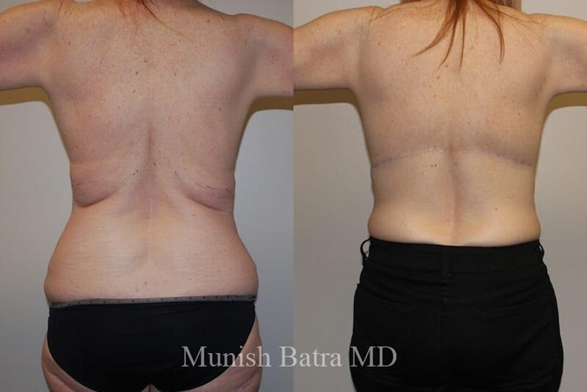 Back Excision Before & After Gallery - Patient 203972 - Image 1