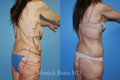 Back Excision Before & After Gallery - Patient 305653 - Image 1