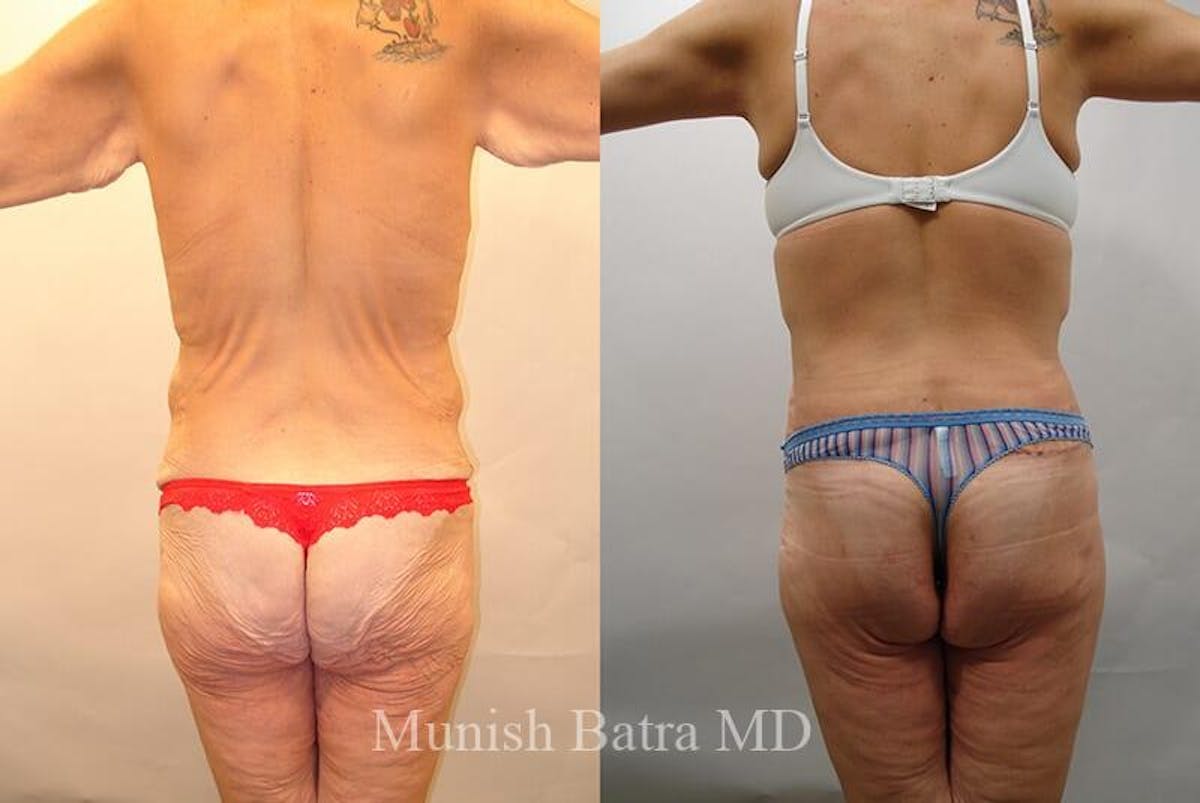 Back Excision Before & After Gallery - Patient 114505 - Image 1