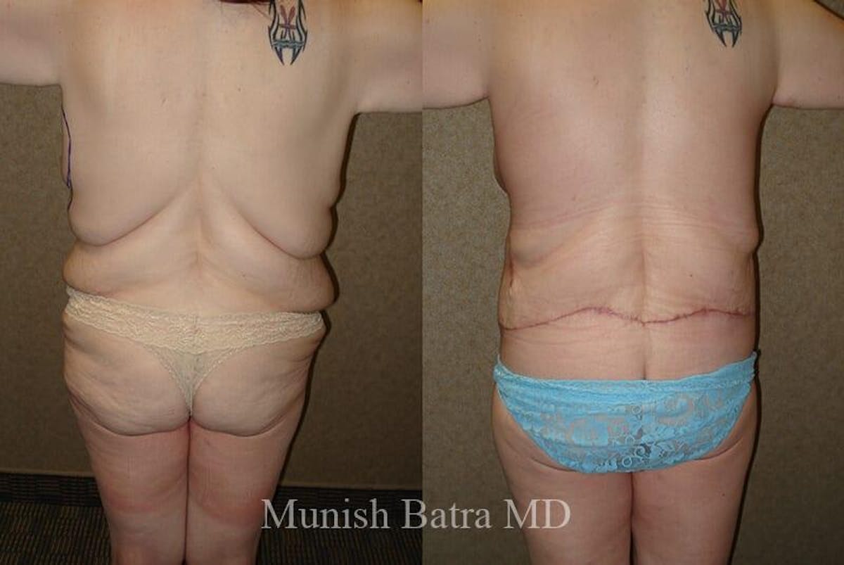 Back Excision Before & After Gallery - Patient 193454 - Image 1