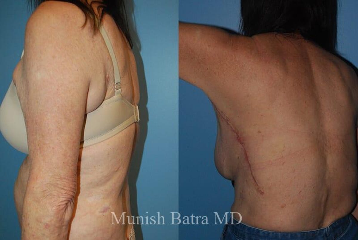 Back Excision Before & After Gallery - Patient 390596 - Image 1
