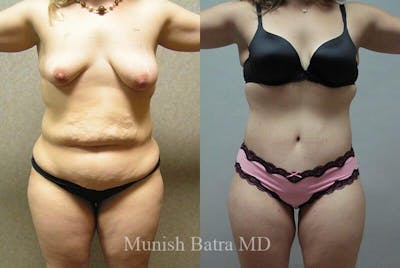 GBRX Abdominoplasty Reconstruction Before & After Gallery - Patient 459404 - Image 1