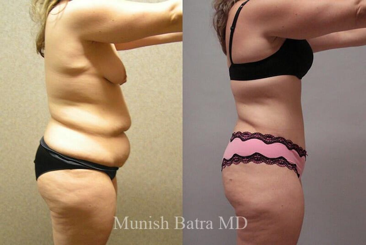 GBRX Abdominoplasty Reconstruction Before & After Gallery - Patient 459404 - Image 2