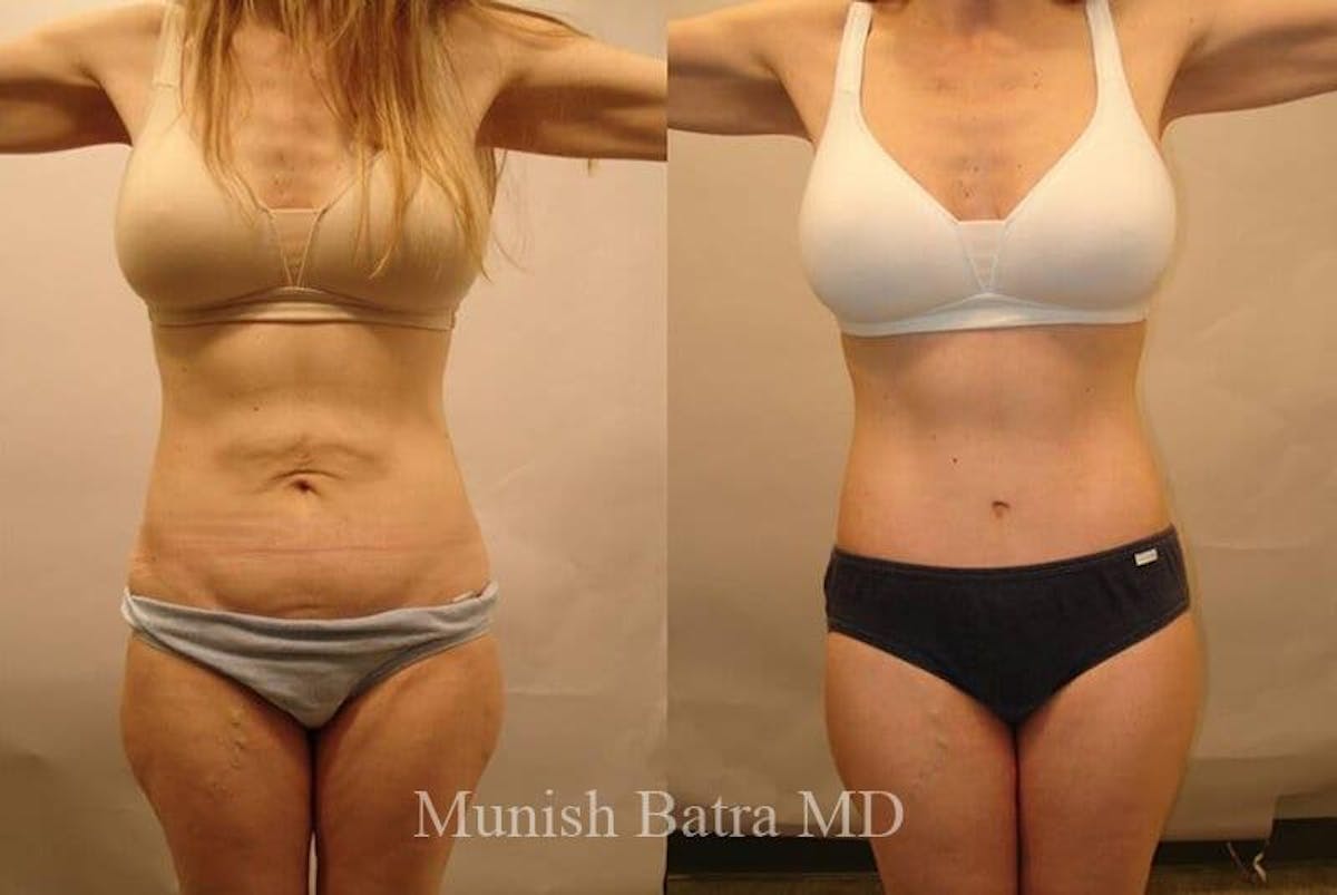 GBRX Abdominoplasty Reconstruction Before & After Gallery - Patient 362590 - Image 1
